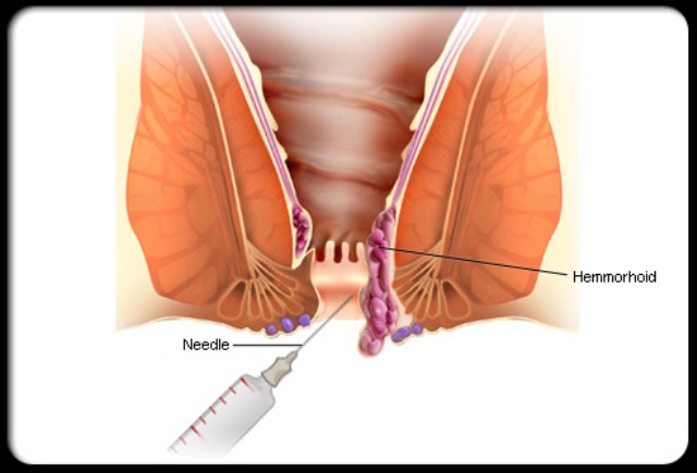 Kashid Hospital Piles Treatment Ahmednagnar